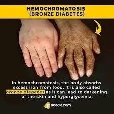 Why Does Copper Excess Cause Bronze Diabetes?