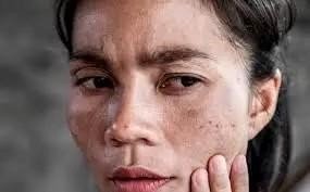 Bronze Diabetes Face