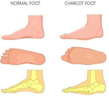 Charcot Foot: A Serious Complication of Diabetes