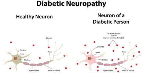 Diabetic Neuropathy: Causes, Symptoms, and Treatment