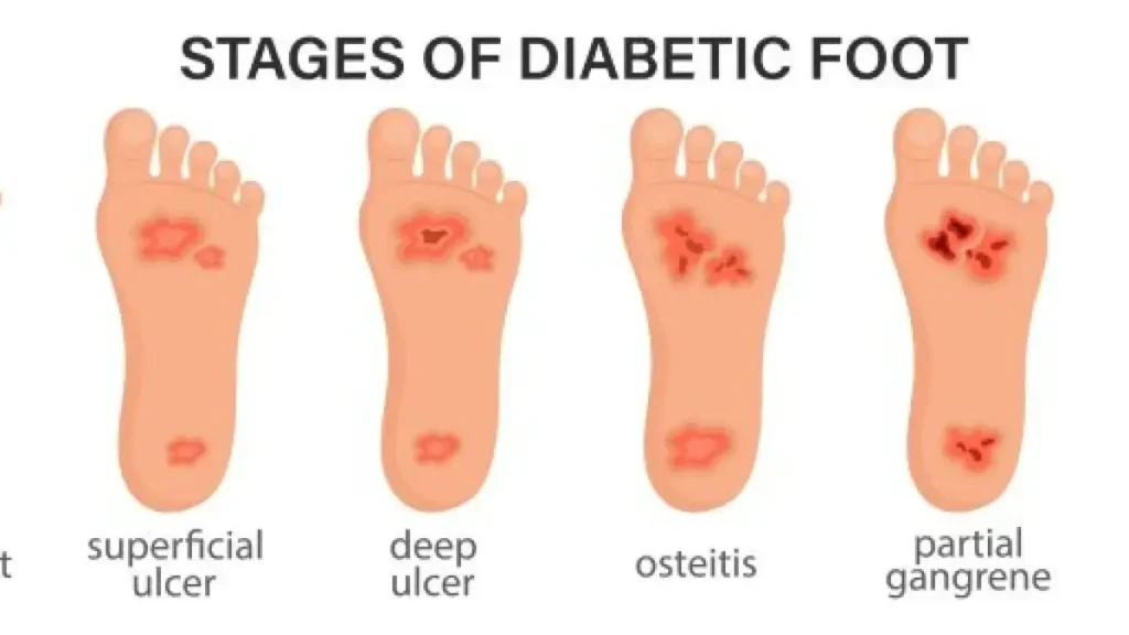Stages of Diabetic Foot Complications
