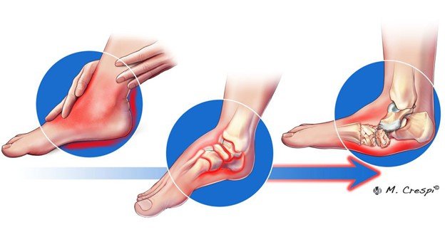 Symptoms and Warning Signs of Charcot foot 