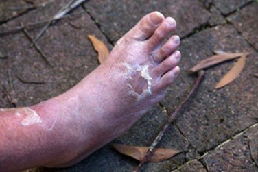 Diabetic Foot Infections: Causes, Symptoms, and Treatment