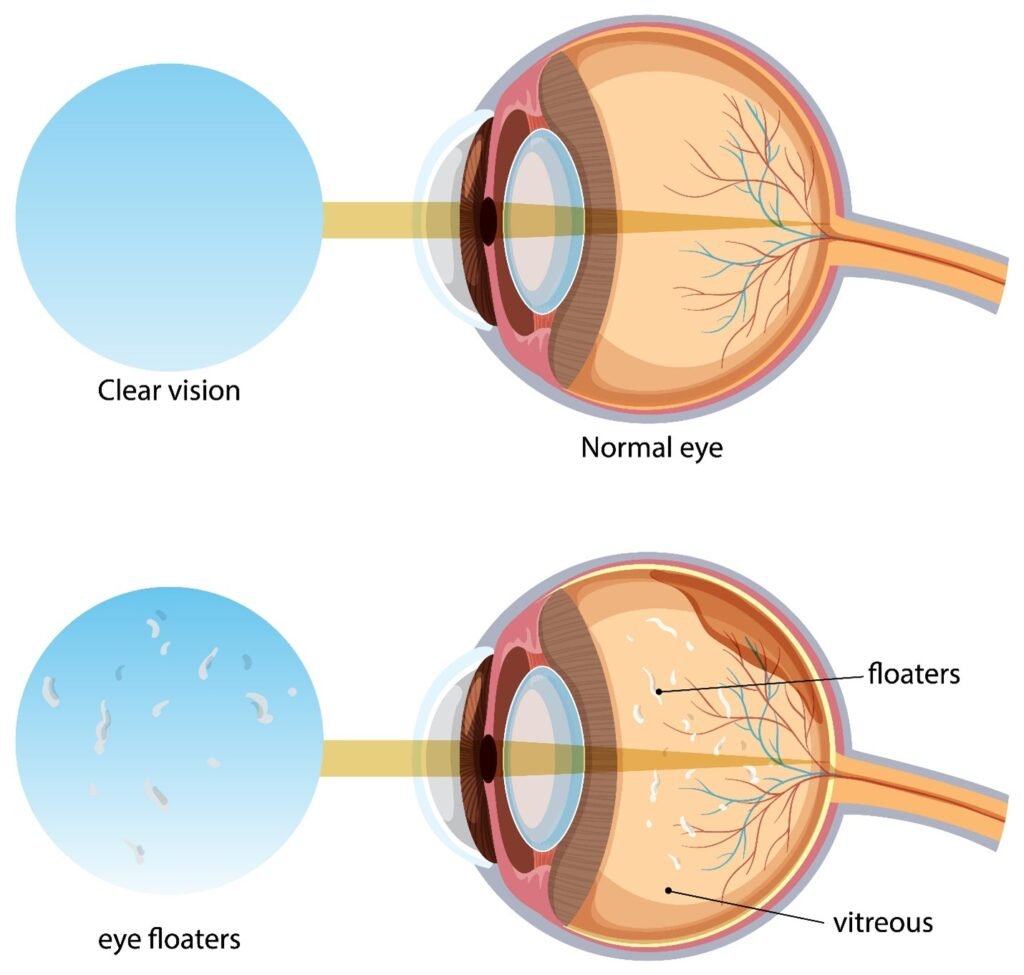 Diabetic Retinopathy