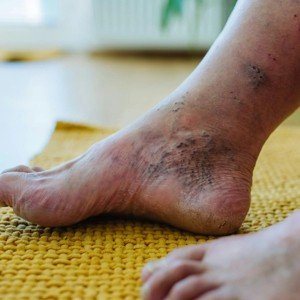 Diagnosis of Diabetic Foot Infections