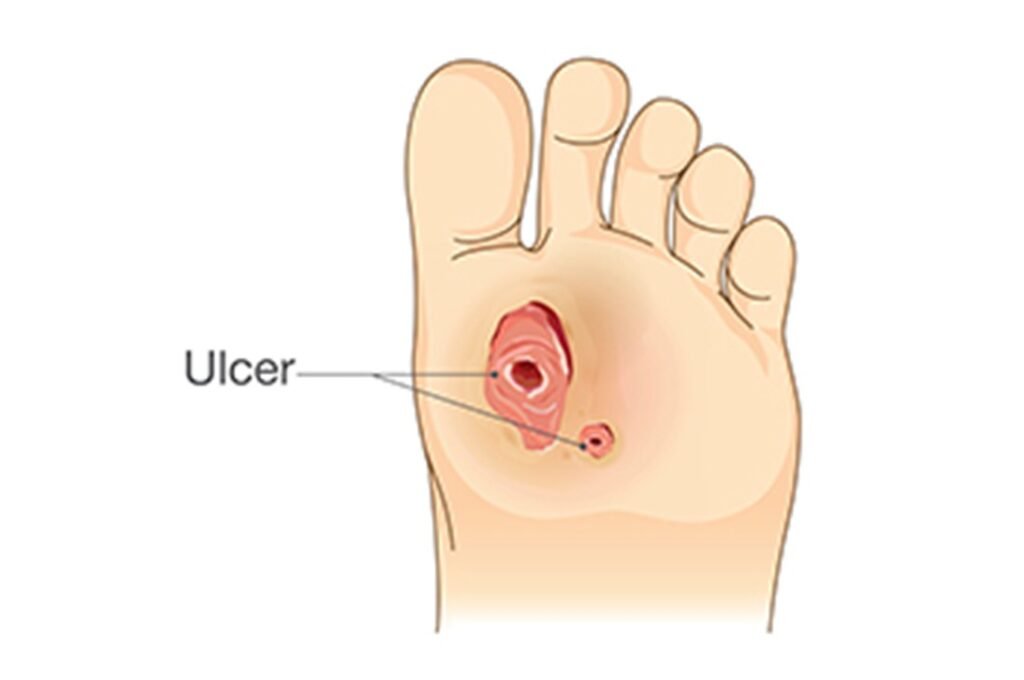 Foot Care in Preventing Diabetic Foot Ulcers