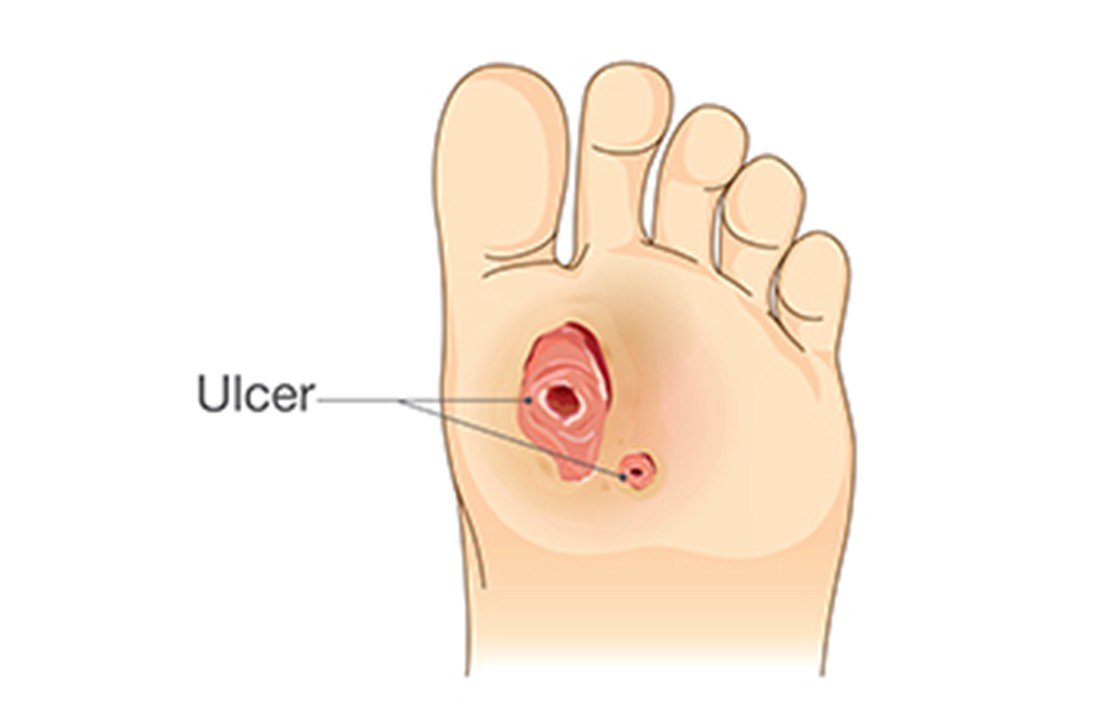 The Importance of Foot Care in Preventing Diabetic Foot Ulcers