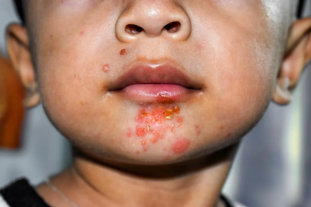 Impetigo
