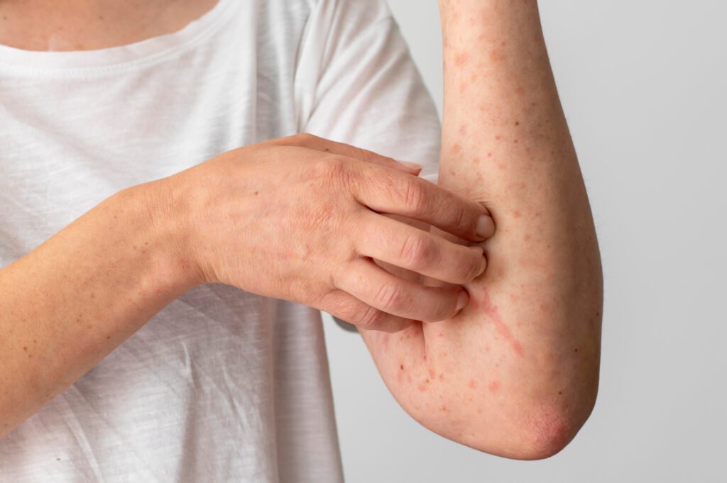 Keratosis Pilaris