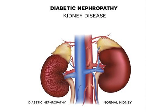 The Pathophysiology of Diabetic Nephropathy