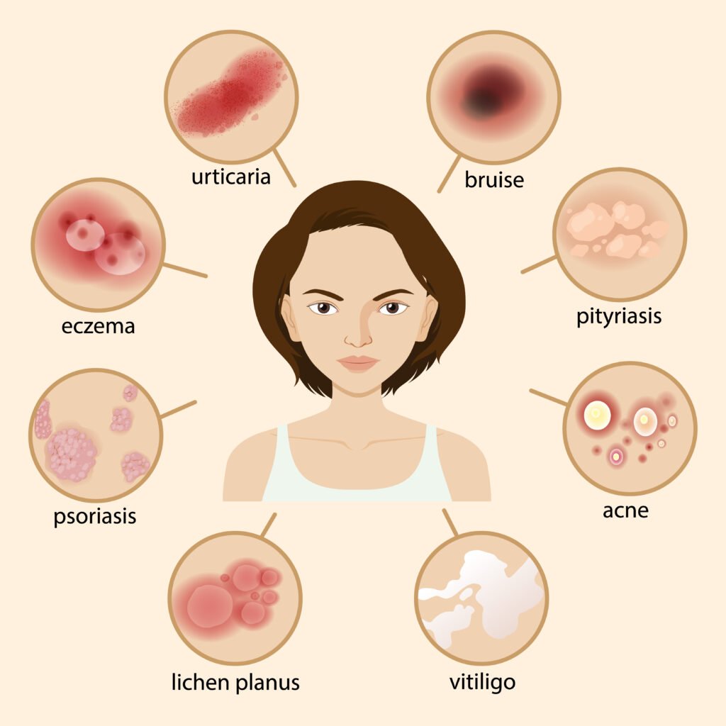 Seborrheic Dermatitis