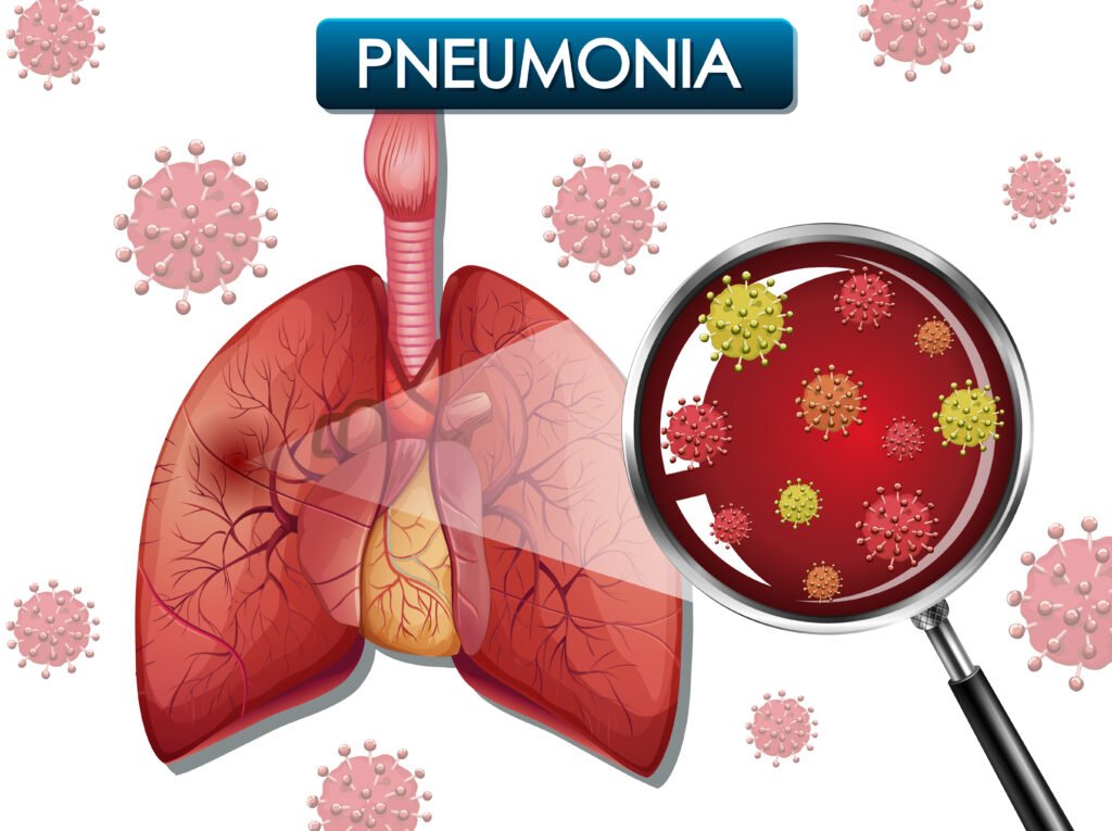 Walking Pneumonia