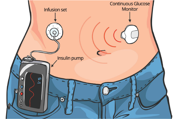 Continuous Subcutaneous Insulin Infusion: A Modern Approach to Diabetes Management