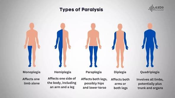Types of Paralysis