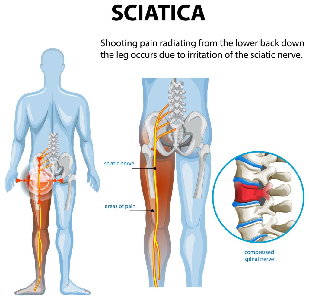 Sciatica